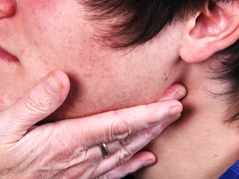 ADVIERTEN SOBRE UN BROTE DE PAPERAS EN LA PROVINCIA