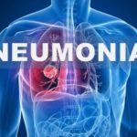 neumonia